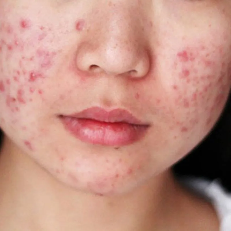 Không nên trang điểm trong tình trạng mụn viêm nghiêm trọng