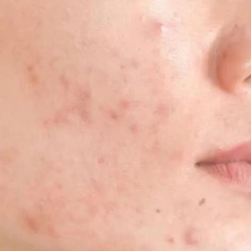 Điện di hỗ trợ làm dịu da, giảm sưng viêm
