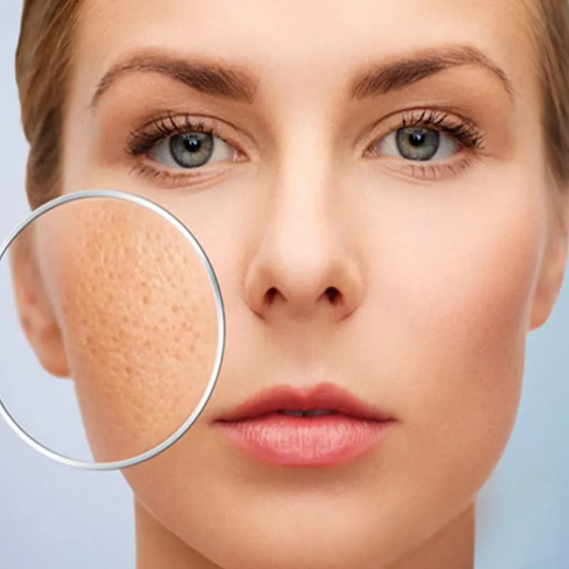 Se khít lỗ chân lông và giảm bã nhờn