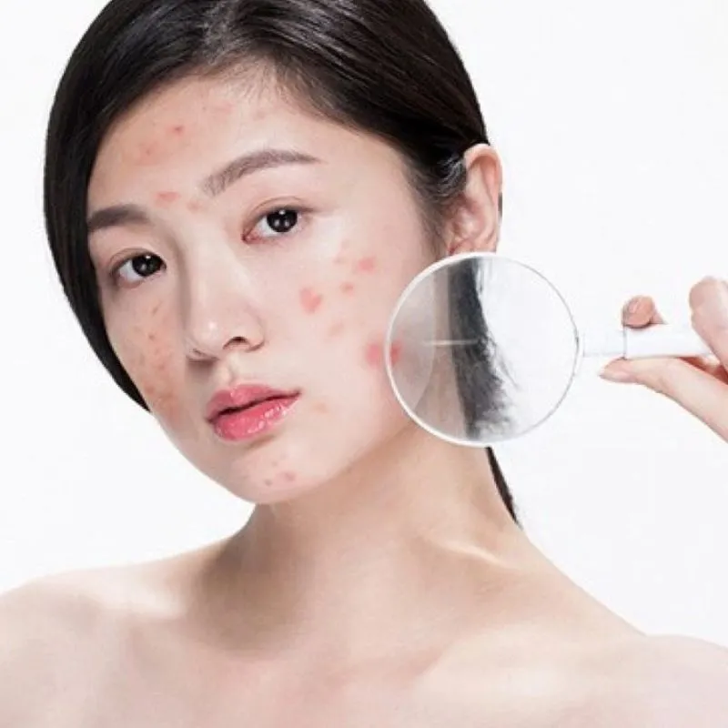 Điện di sau nặn mụn có tác dụng gì?