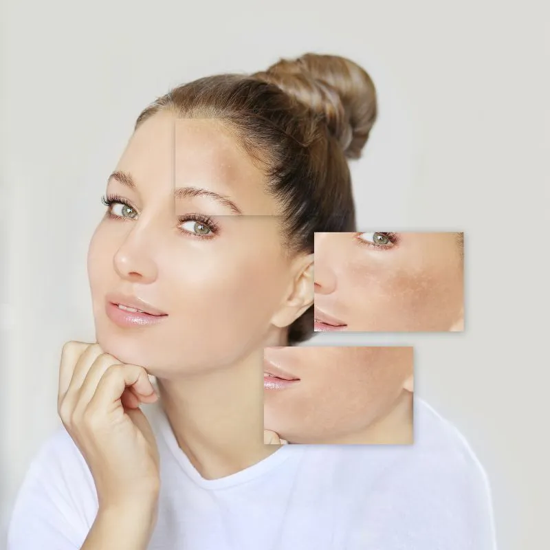 Máy điện di hỗ trợ giảm thâm nám và làm đều màu da
