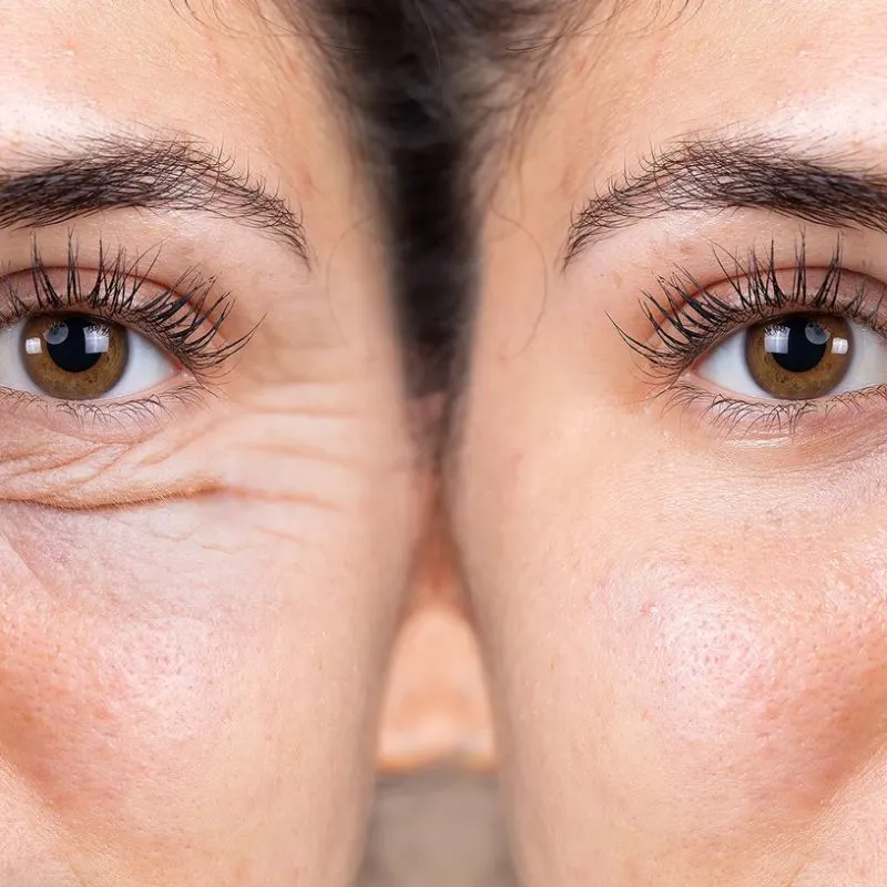 Tiêm botox xóa nhăn giữ được bao lâu?