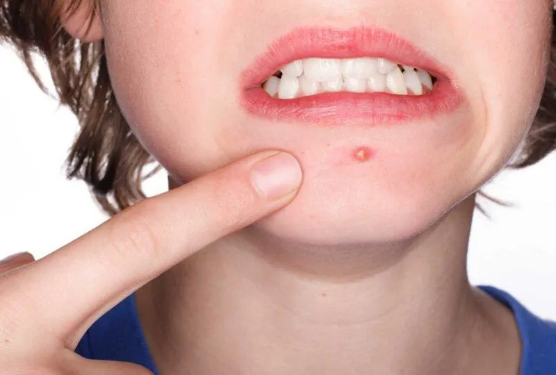 Cách trang điểm che mụn sưng đỏ không dấu vết