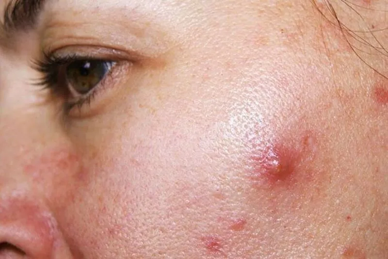 Bị mụn sưng đỏ có nên trang điểm không? 