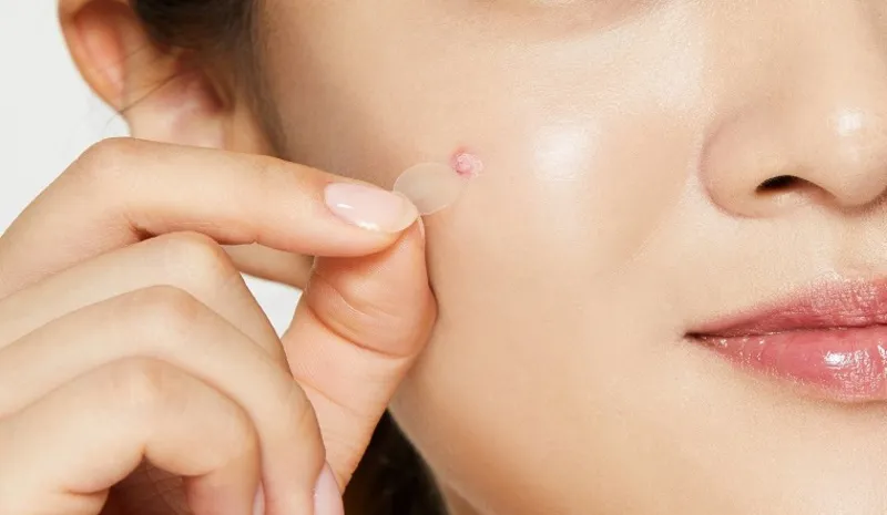 Cách che vết thâm mụn không cần trang điểm