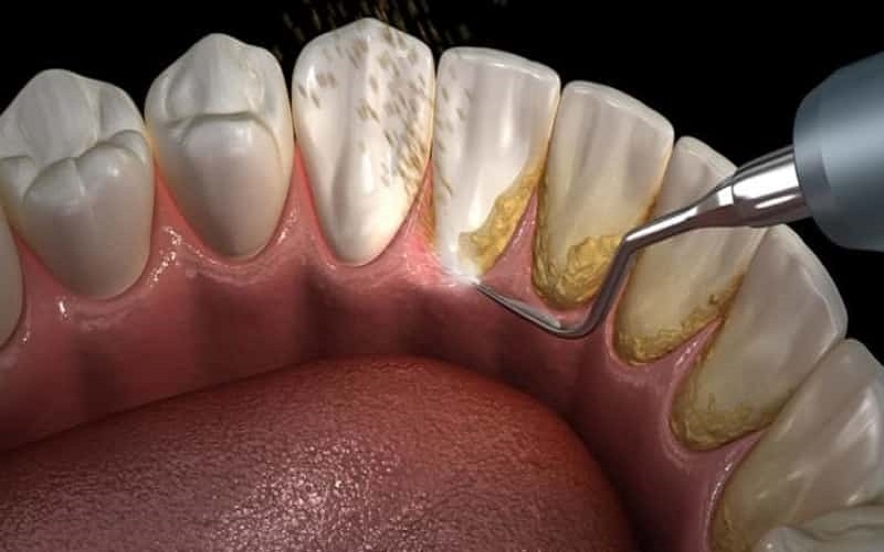 Thực hư máy tăm nước có lấy được cao răng không?